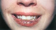 Oral Melanotic Macule in Adults: Condition, Treatments ...