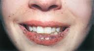 freckles on lip #10