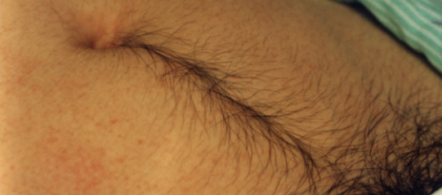 Get Rid Of Stomach Hair Naturally Get Rid Of Stomach Hair Naturally