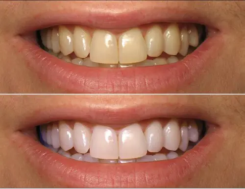 Before and after home teeth whitening with coconut oil e1445171893878 - Updated Miami