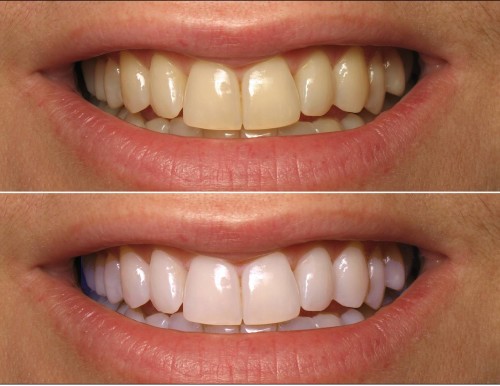 Coconut Oil Before And After coconut oil teeth whitening how to whiten 