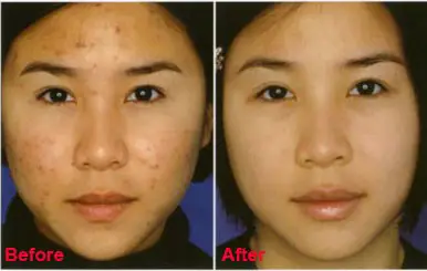 Vitamin E For Scars Before And After