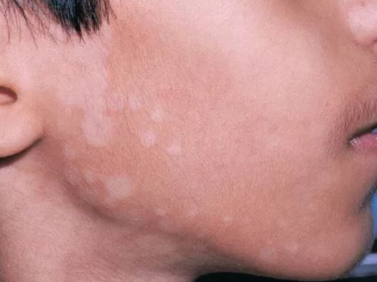 Strange Red and Dry patch on face?! - Dermatology - MedHelp