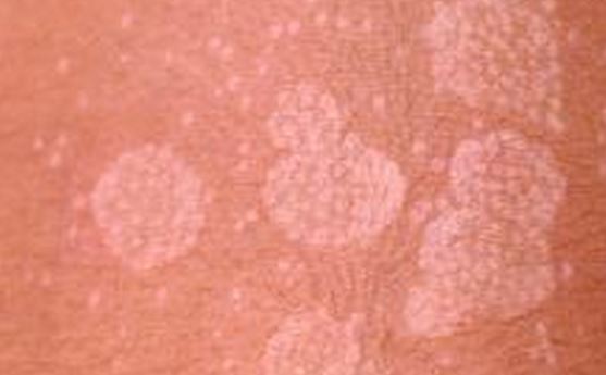Facial White Spots 43