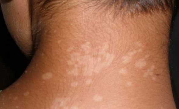 Petechiae Causes Tiny Red Skin Dots, Little Red Skin Spots ...