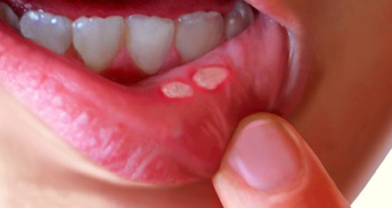 What causes mouth blisters?