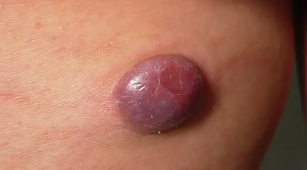 blood spots on scrotum