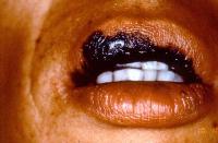 Lip Melanoma
