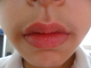 Upper lip hair