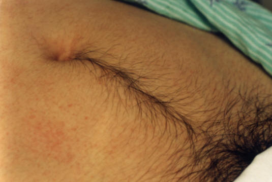 Stomach hair in women