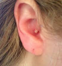 Painful pimple in ear