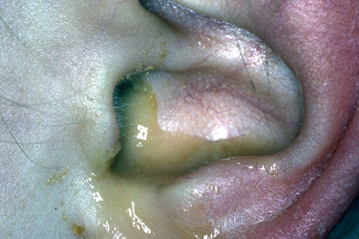 Painful pimple in ear canal, behind ear, symptoms 