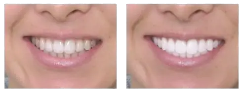 Zoom teeth whitening uk