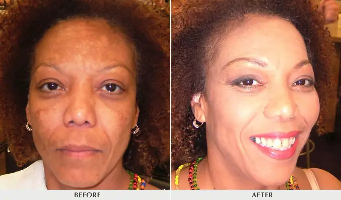 Turmeric for skin lightening before and after