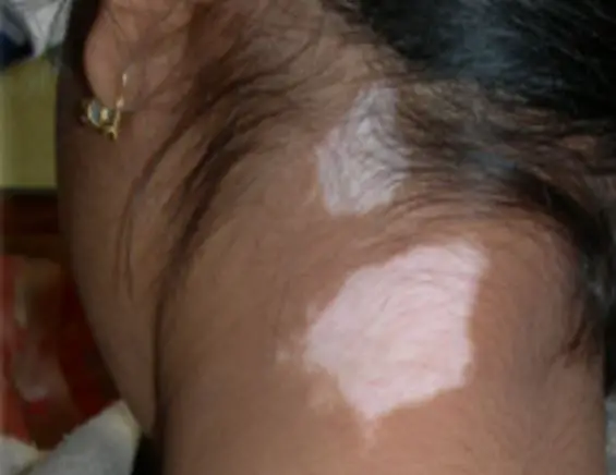 White patches on skin - back of neck
