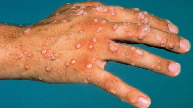 How to Remove Warts, Get Rid of Warts on Hands, Legs, Fast ...