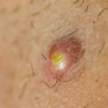 Lump On Inner Thigh Small Red Bumps Painful Lumps Female Male Lump Under Skin Won T Pop Get Rid Treat