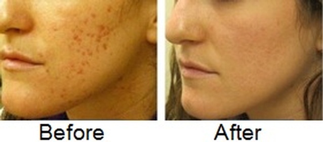 How to Fade Acne Scars Fast, Naturally, Diminish Acne 