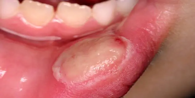 Inside of Mouth Peeling