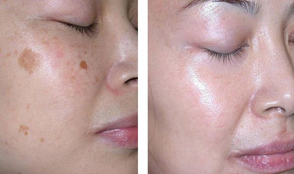 acne on for onion face and Fast to Age on Face,Hands Get How of Spots Legs, rid