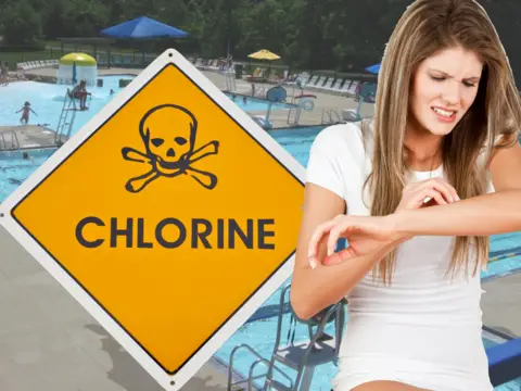 Chlorine Allergy.