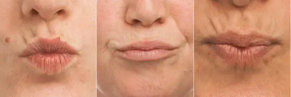 Wrinkles around Lips