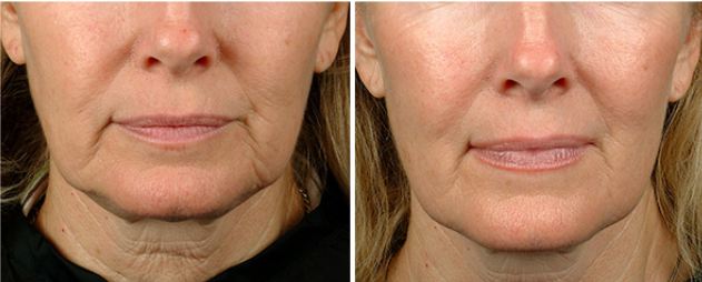 Before and After Neck Lift