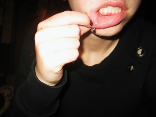 Infected Lip Piercing