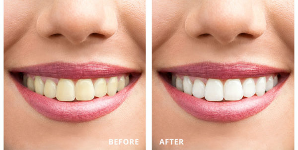 Laser Teeth Whitening, Near Me, Pros and Cons, Side 