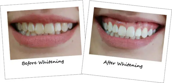 Image result for teeth before after