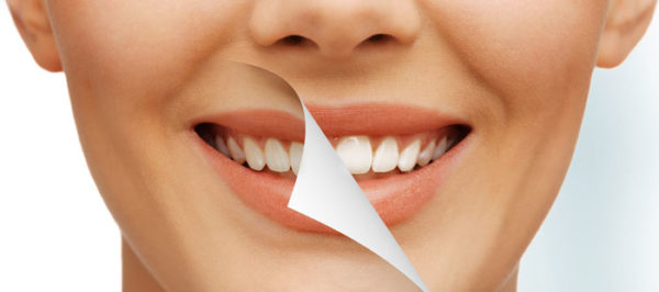 Laser Teeth Whitening