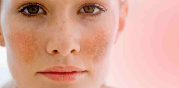 does ice really get rid of pimples