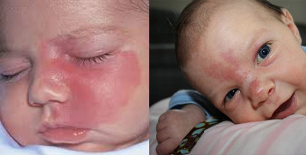 Laser Treatment for Port Wine Stains