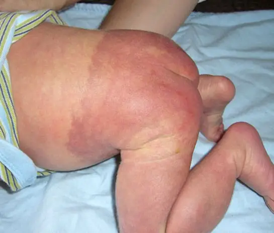 Port Wine Stain