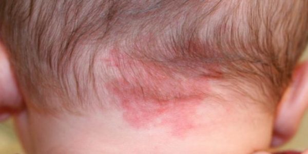 Stork Bite Birthmark Stork Bite Birthmark