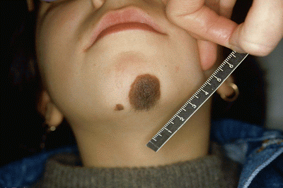 Congenital Melanocytic Nevus