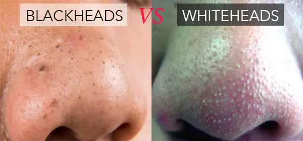 Whiteheads on Nose, Causes, Get Rid of Whiteheads on Nose 