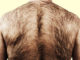 Back Hair Removal