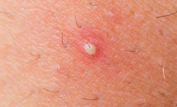 home remedies for boils in buttocks crack