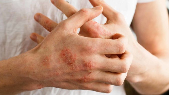 Home Remedies for Eczema