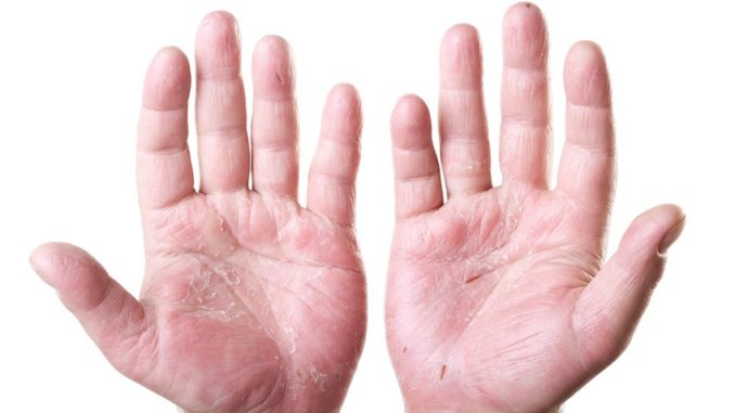 Rosacea vs Eczema Rosacea vs Eczema