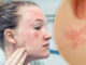How to get rid of Eczema on the Face