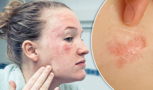 How to get rid of Eczema on the Face