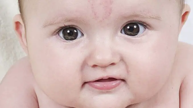 Salmon Patches Angel Kiss Baby Birthmark