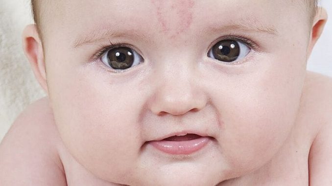 salmon patch angel kiss baby face Salmon Patches Angel Kiss Baby Birthmark
