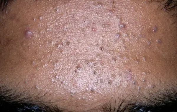 Comedonal Acne