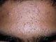 Comedonal Acne