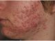 What is Nodular Acne