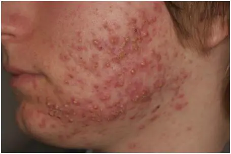What is Nodular Acne
